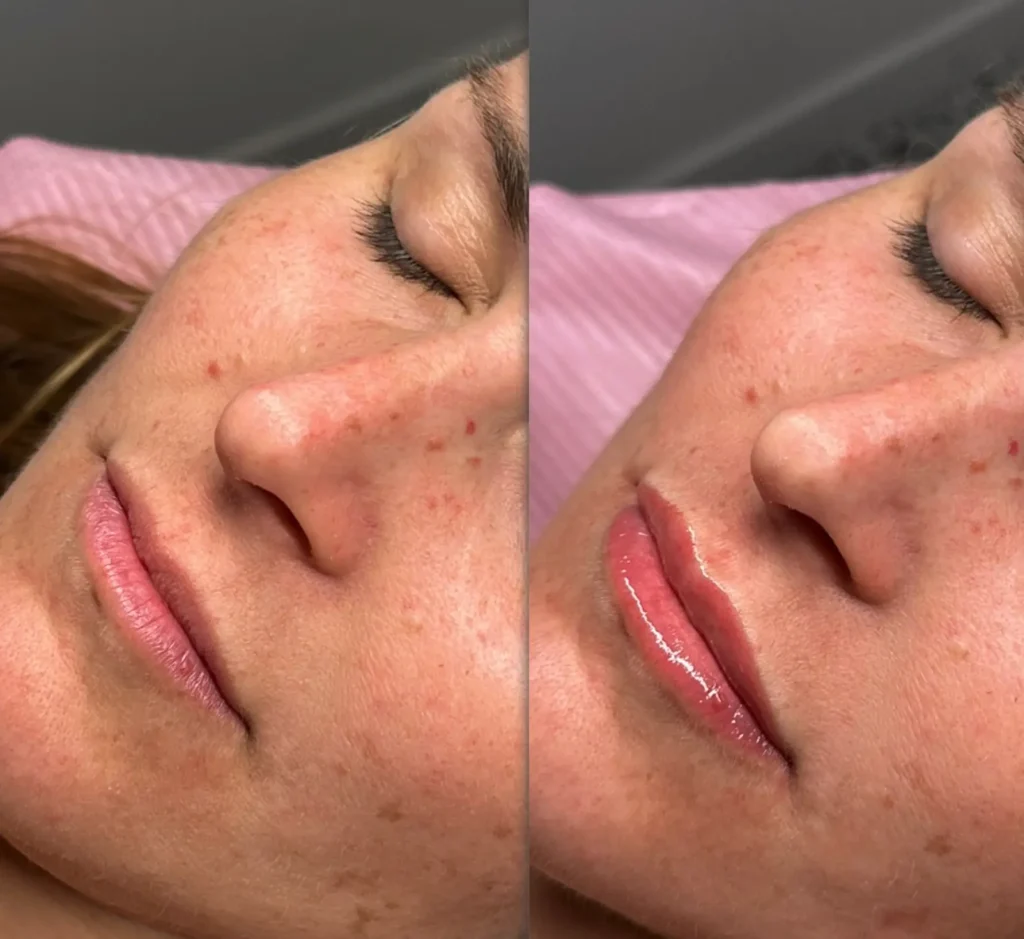 cosmetic tattooing