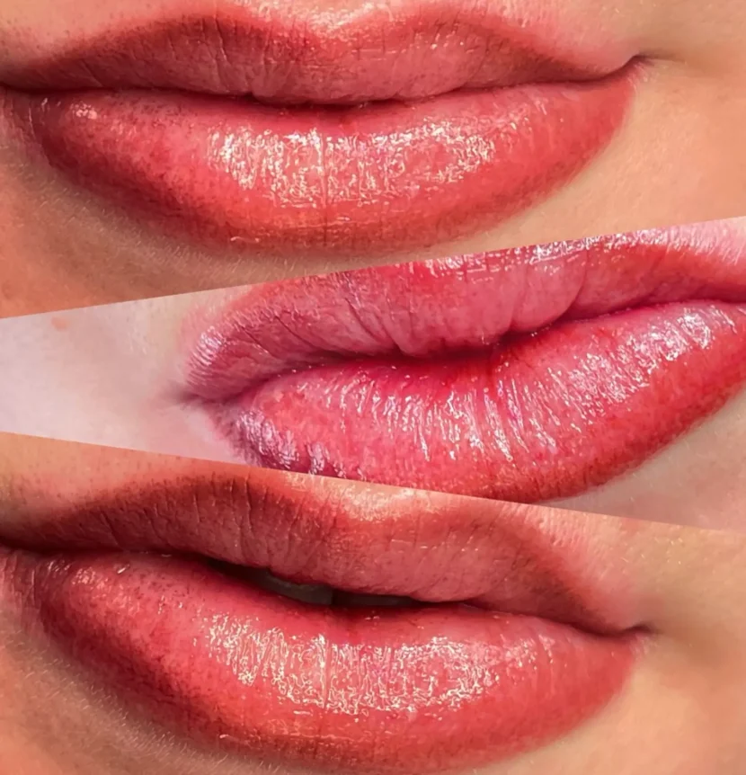 What is Cosmetic Tattoo Granuloma?