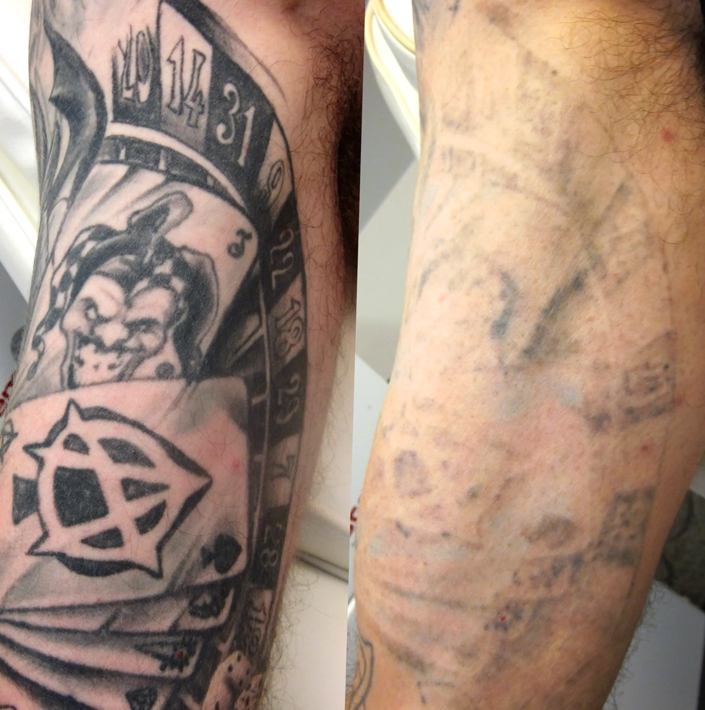 colour tattoo removal Melbourne