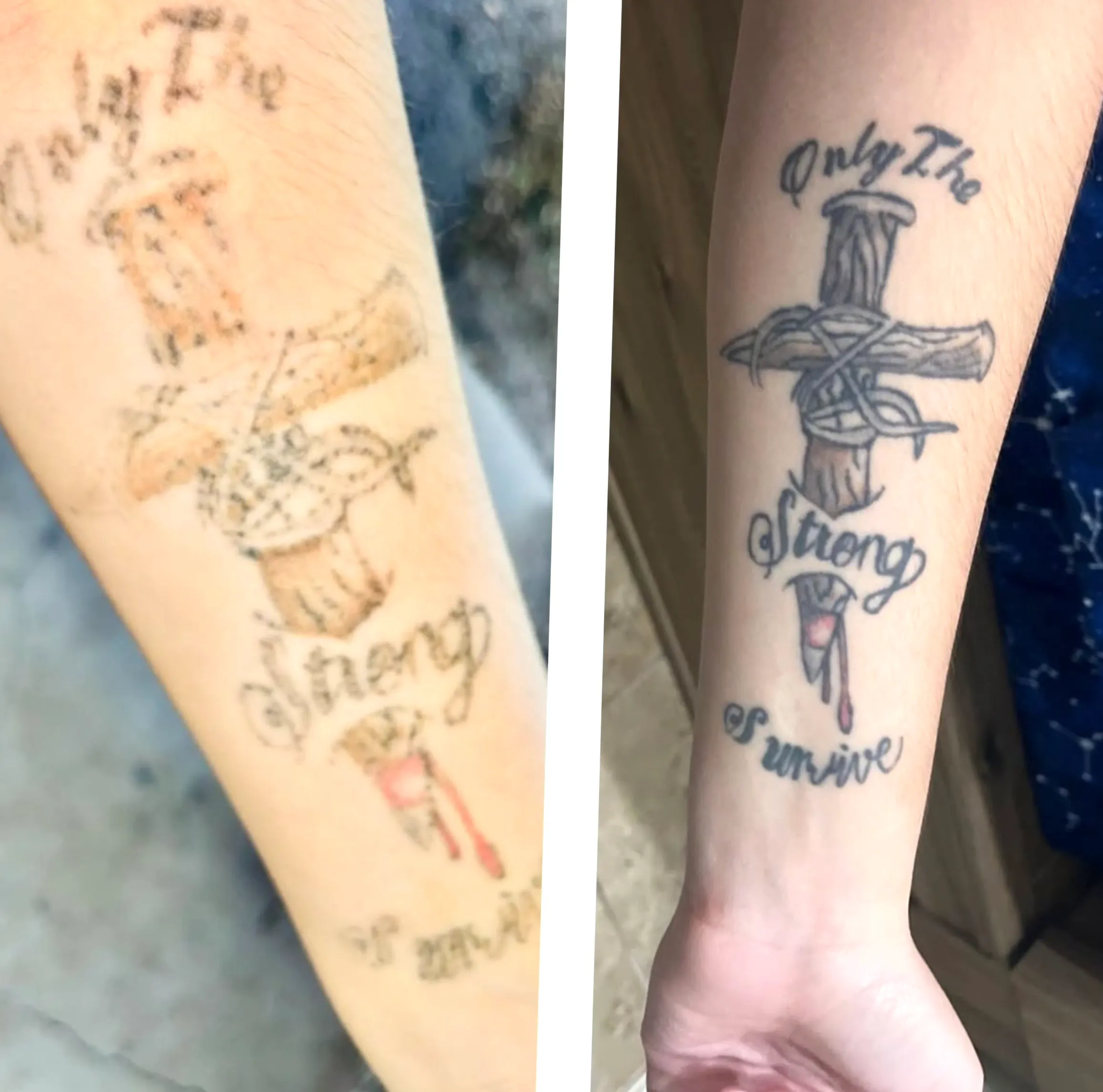 saline tattoo removal vs laser