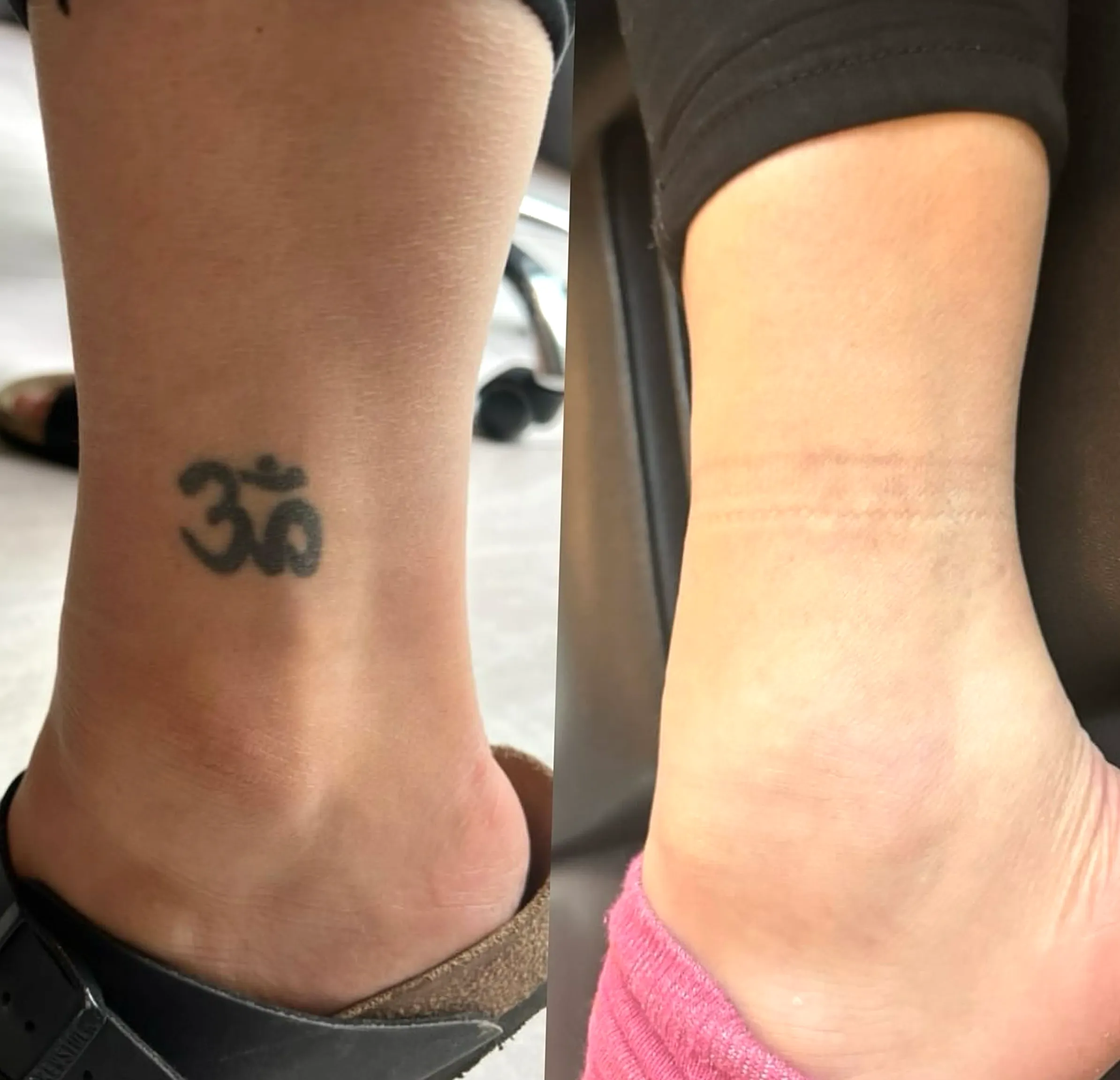laser eyeliner tattoo remova