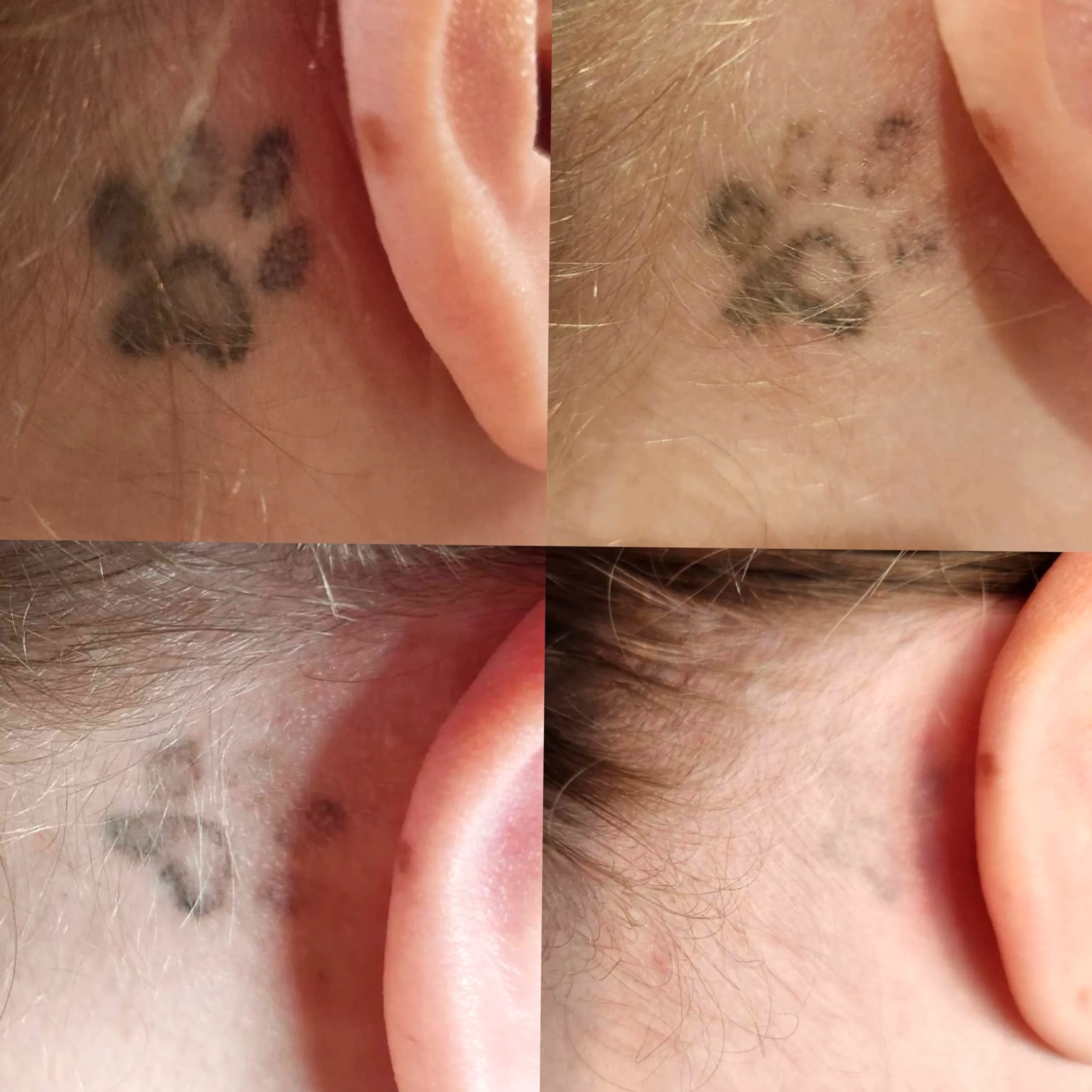 white ink tattoo removal