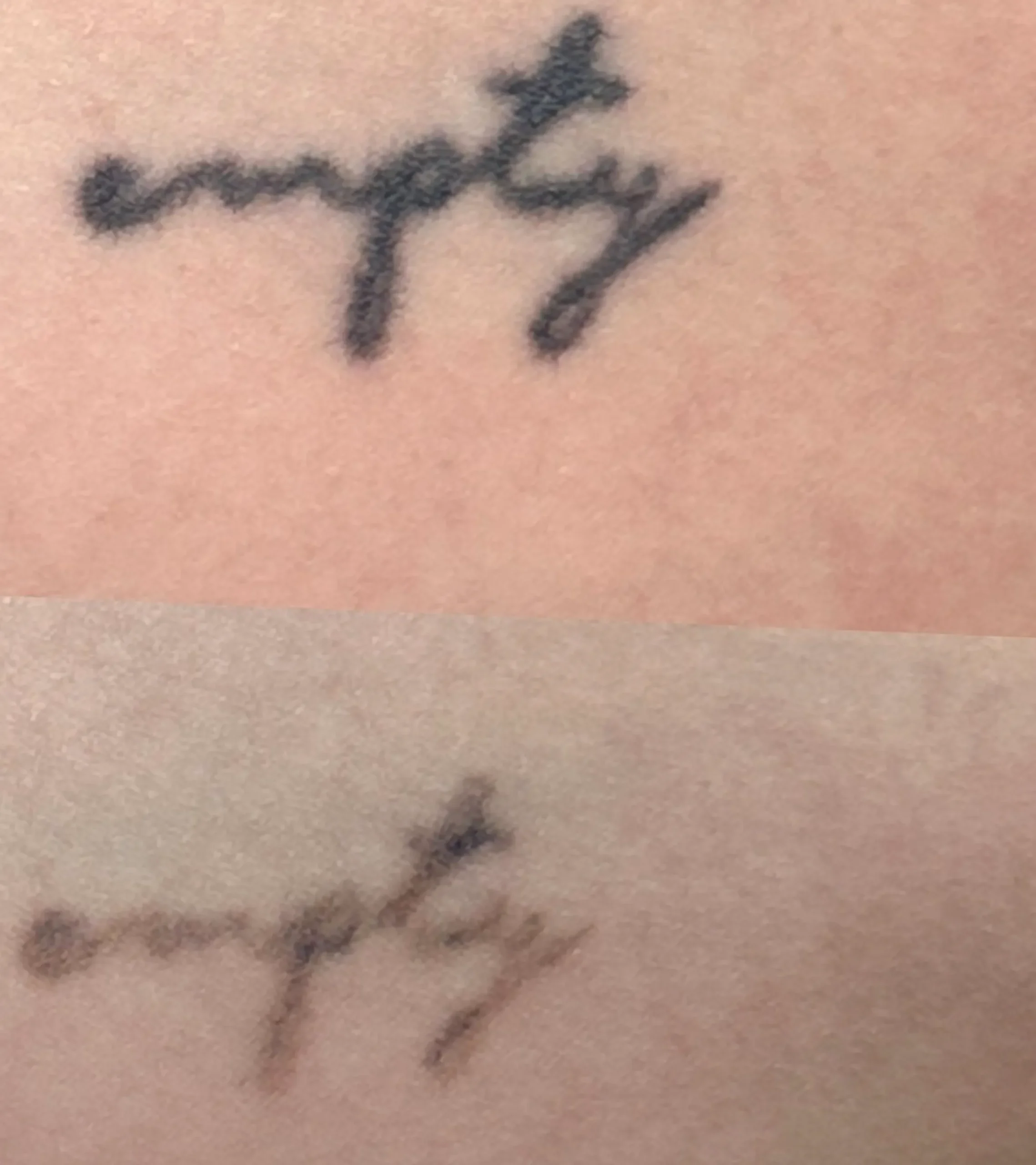 hardest tattoo colors to remove