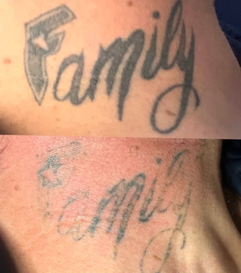 tattoos that can't be removed