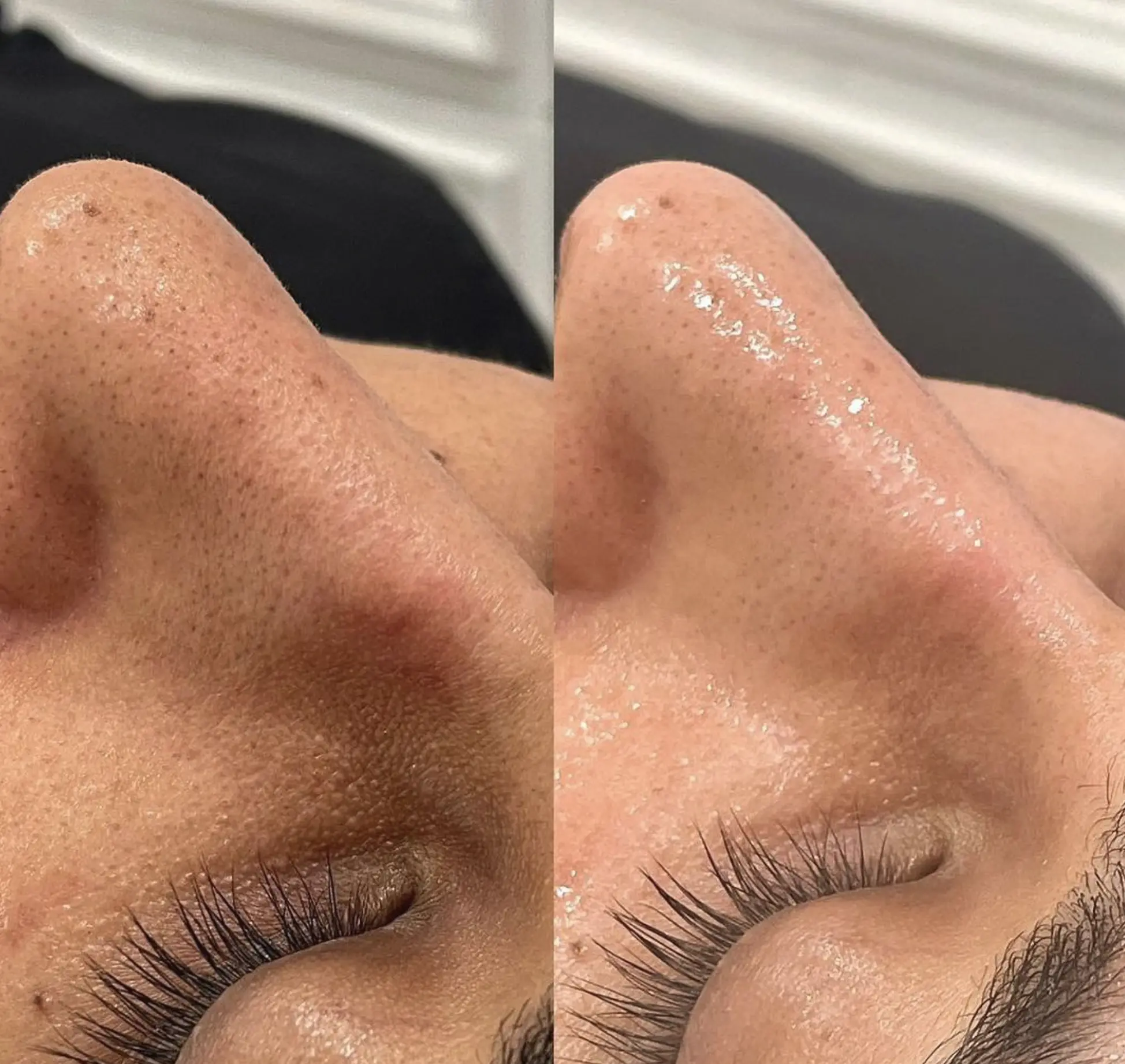 hydrafacial australia