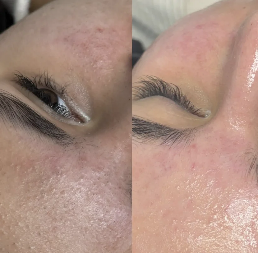 hydrafacial boosters
