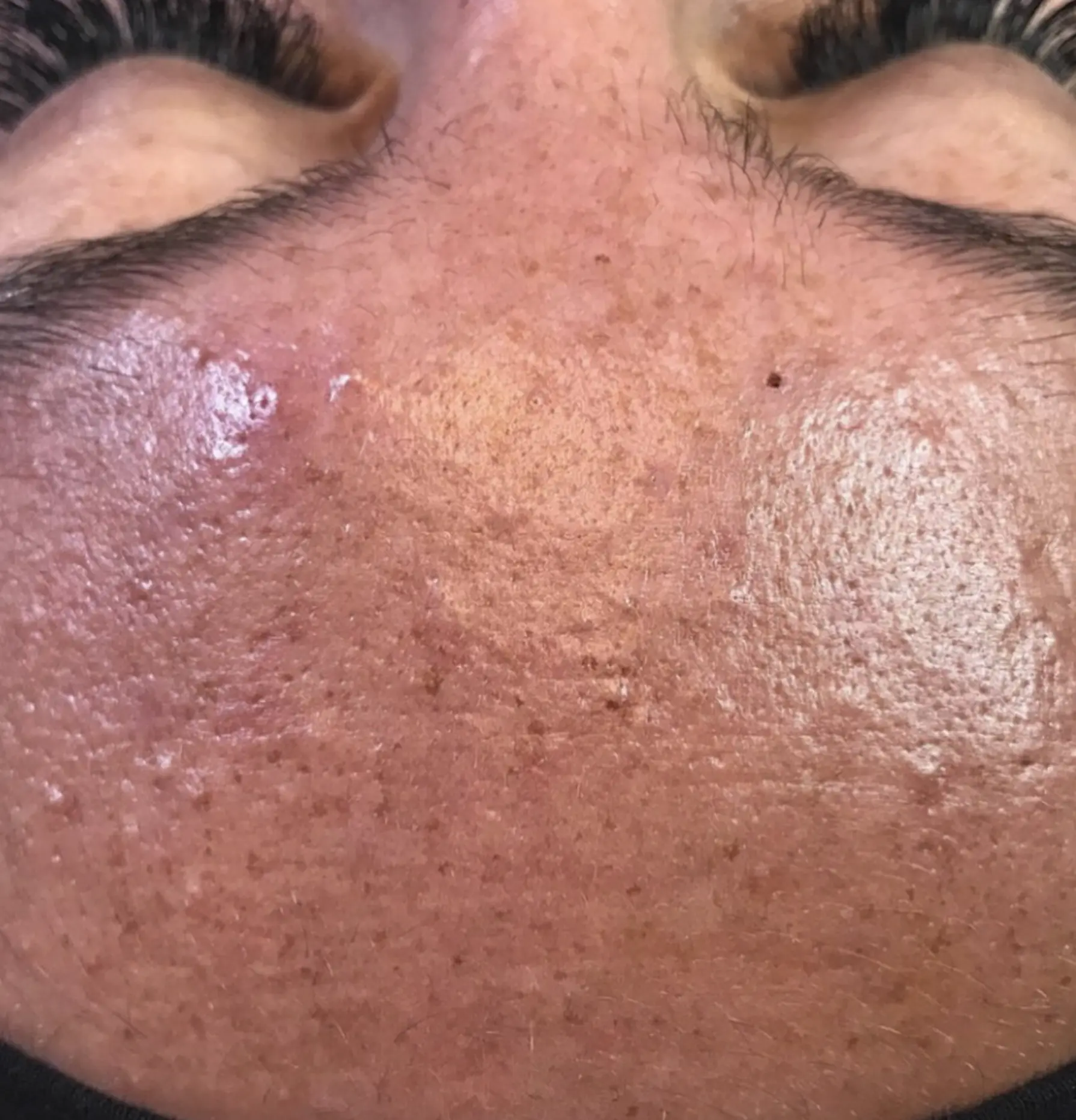 hydrafacial treatment